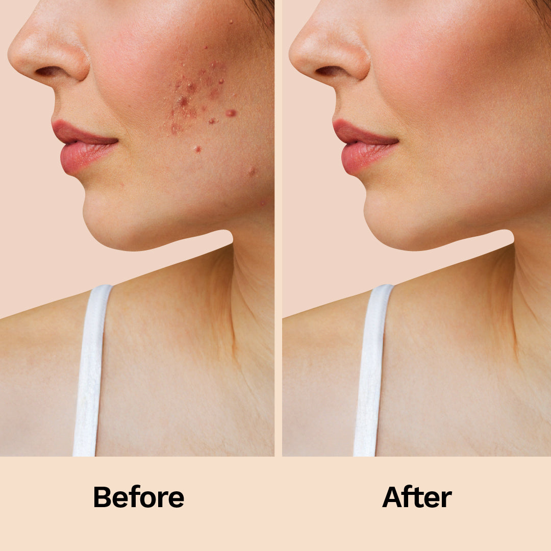 Furr Acne Relief Patches (30 Patches)