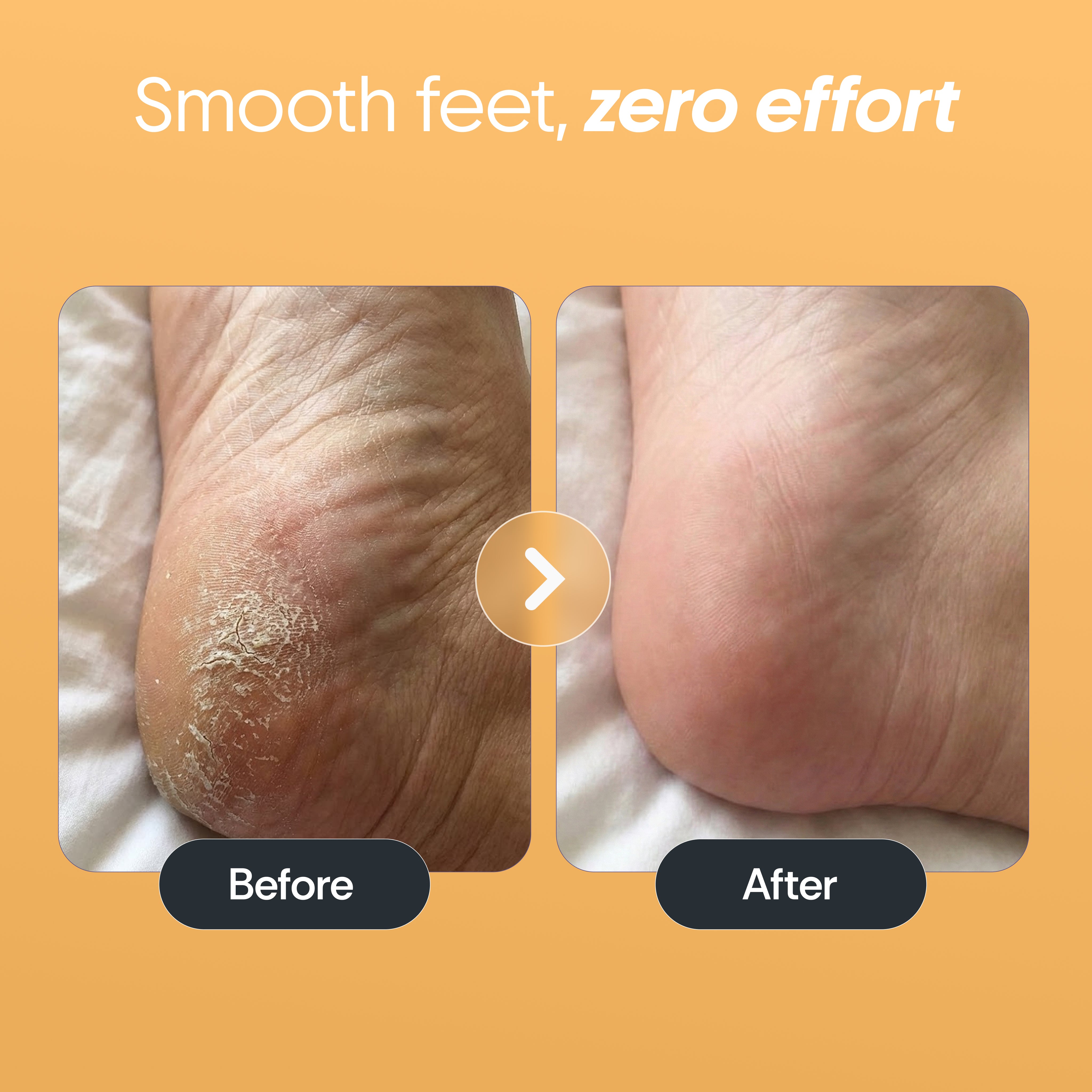 Furr Foot Callus Remover