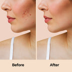 Furr Pimple Patches 12N