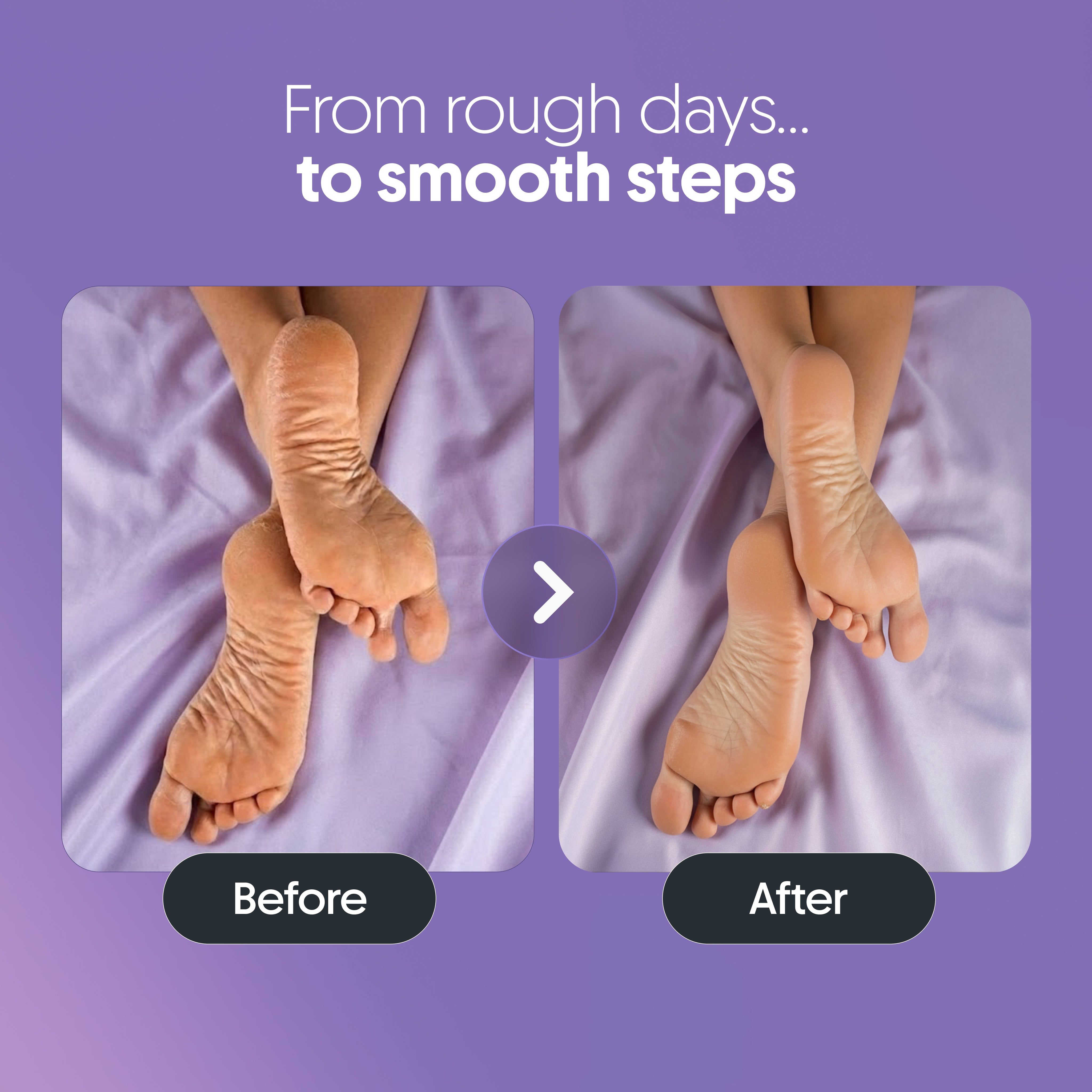 Furr Urea & Natural AHAs Foot Cream - (BYOC)