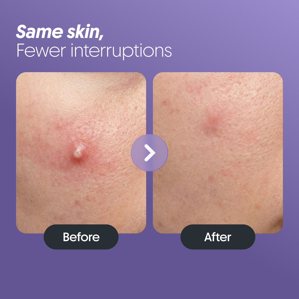 Furr Pimple Patches (30 Patches)