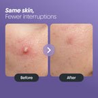 Furr Pimple Patches (30 Patches)